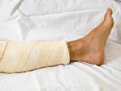 A broken leg